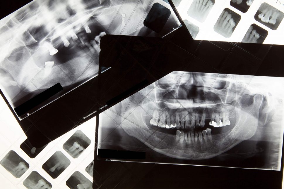 El proceso de la radiografía Dental